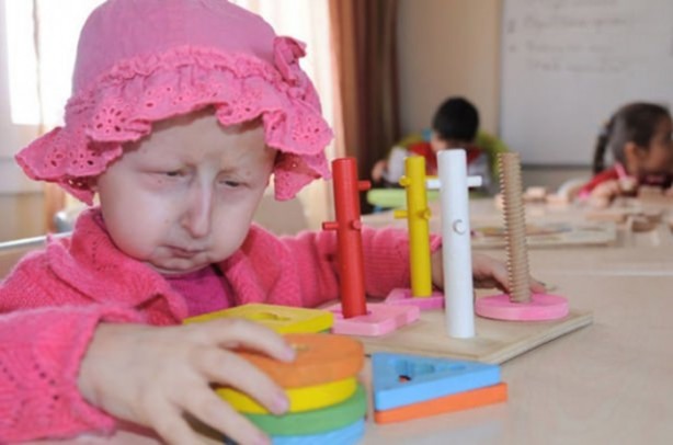 11 yaşını göremez dediler ama...