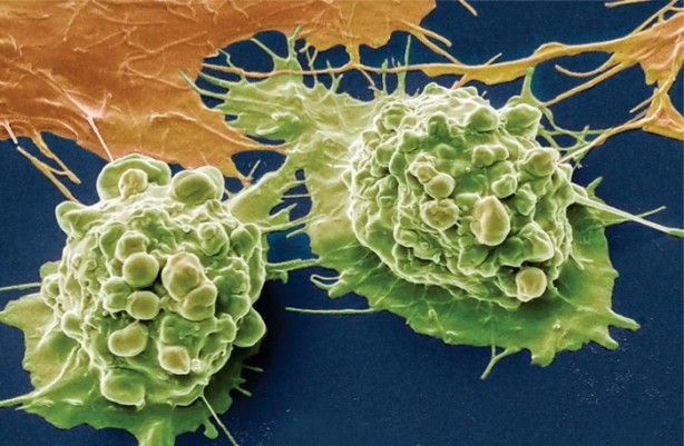 Foto - 15 dakikada kanserden kurtulmak mümkün!