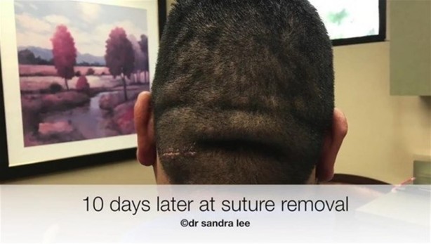 Foto - 17 yıl boyunca beyninde solucanla yaşadı