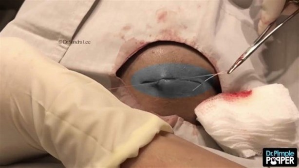 Foto - 17 yıl boyunca beyninde solucanla yaşadı