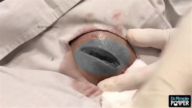 Foto - 17 yıl boyunca beyninde solucanla yaşadı