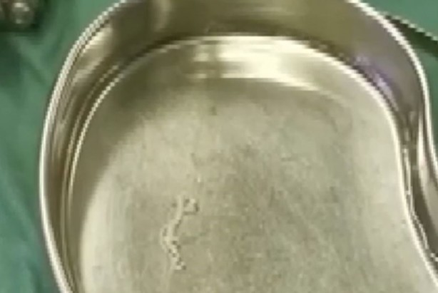 Foto - 17 yıl boyunca beyninde solucanla yaşadı