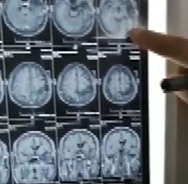 Foto - 17 yıl boyunca beyninde solucanla yaşadı