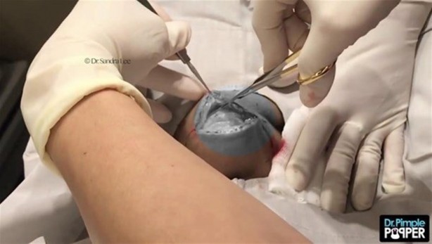 Foto - 17 yıl boyunca beyninde solucanla yaşadı