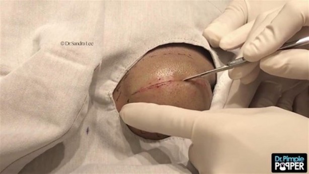 Foto - 17 yıl boyunca beyninde solucanla yaşadı