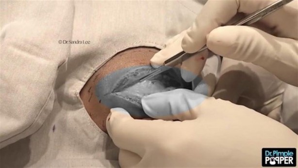 Foto - 17 yıl boyunca beyninde solucanla yaşadı