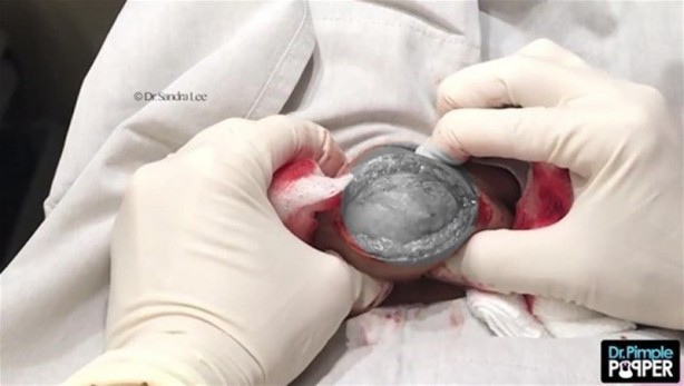 Foto - 17 yıl boyunca beyninde solucanla yaşadı