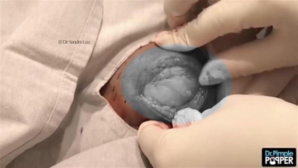 Foto - 17 yıl boyunca beyninde solucanla yaşadı