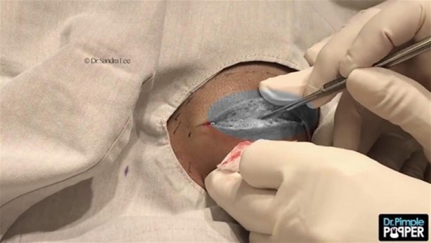 Foto - 17 yıl boyunca beyninde solucanla yaşadı