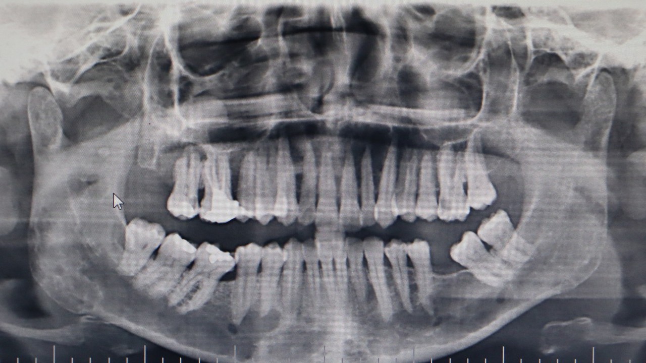 Foto - 2 haftadan uzun sürerse diş hekimine gidin: Bu rahatsızlığı yaşayanların yüzde 25'i ölüyor!