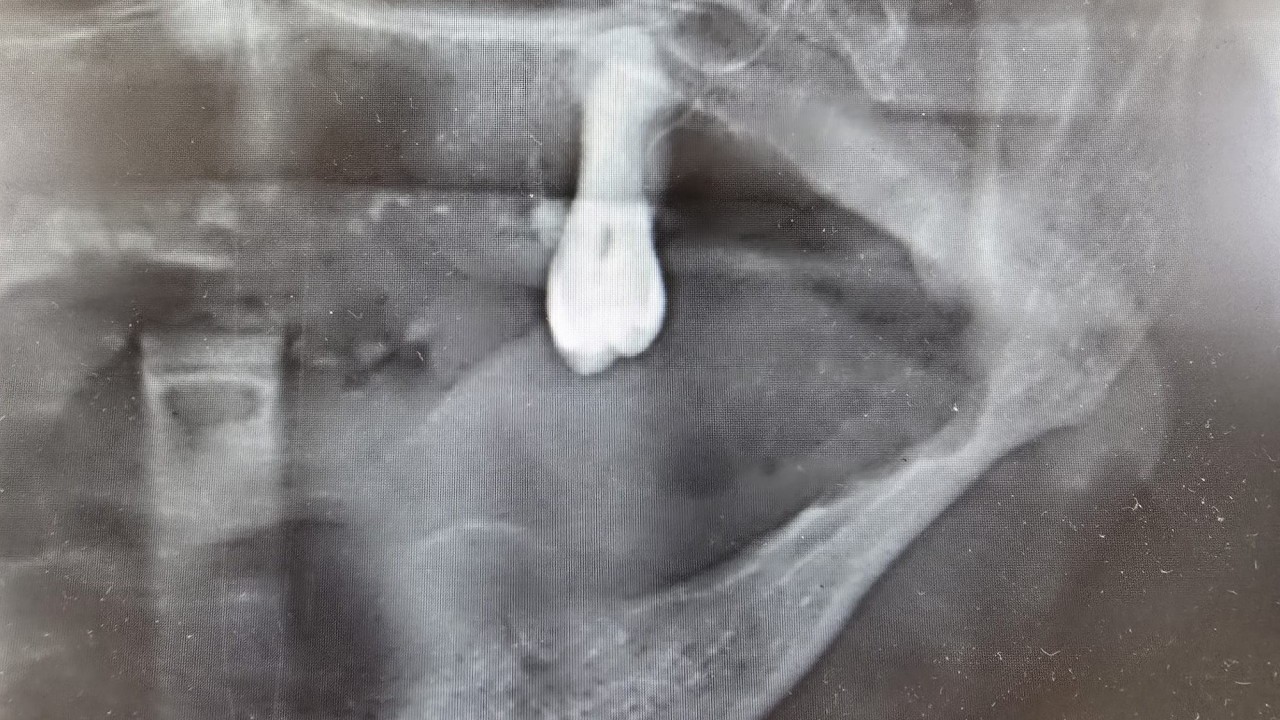 Foto - 2 haftadan uzun sürerse diş hekimine gidin: Bu rahatsızlığı yaşayanların yüzde 25'i ölüyor!