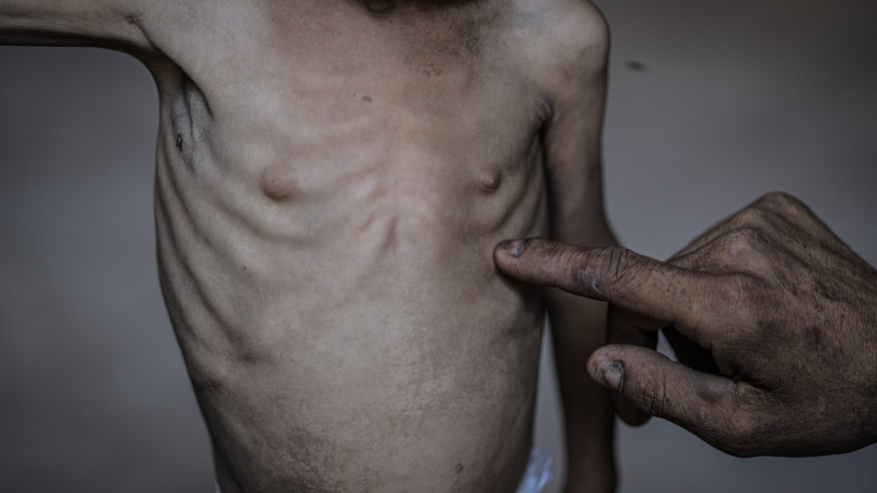 Foto - 2 yaşında... Ölümle karşı karşıya!..