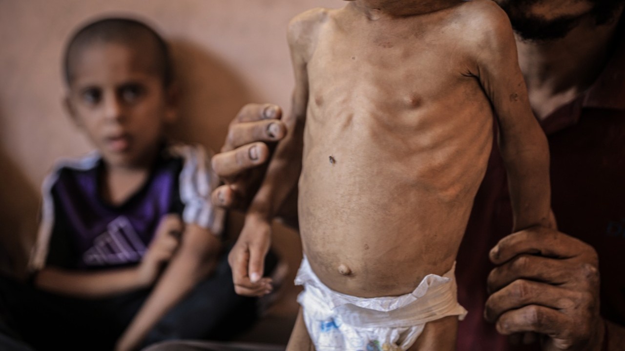 Foto - 2 yaşında... Ölümle karşı karşıya!..