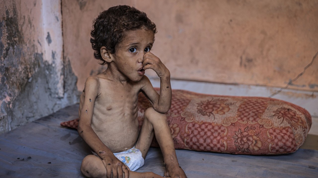 Foto - 2 yaşında... Ölümle karşı karşıya!..