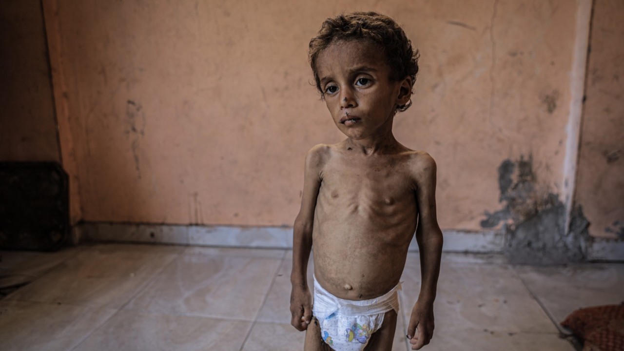 Foto - 2 yaşında... Ölümle karşı karşıya!..