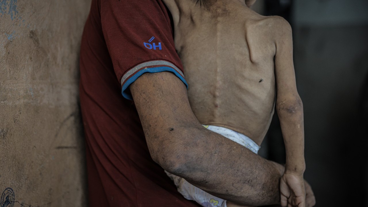 Foto - 2 yaşında... Ölümle karşı karşıya!..