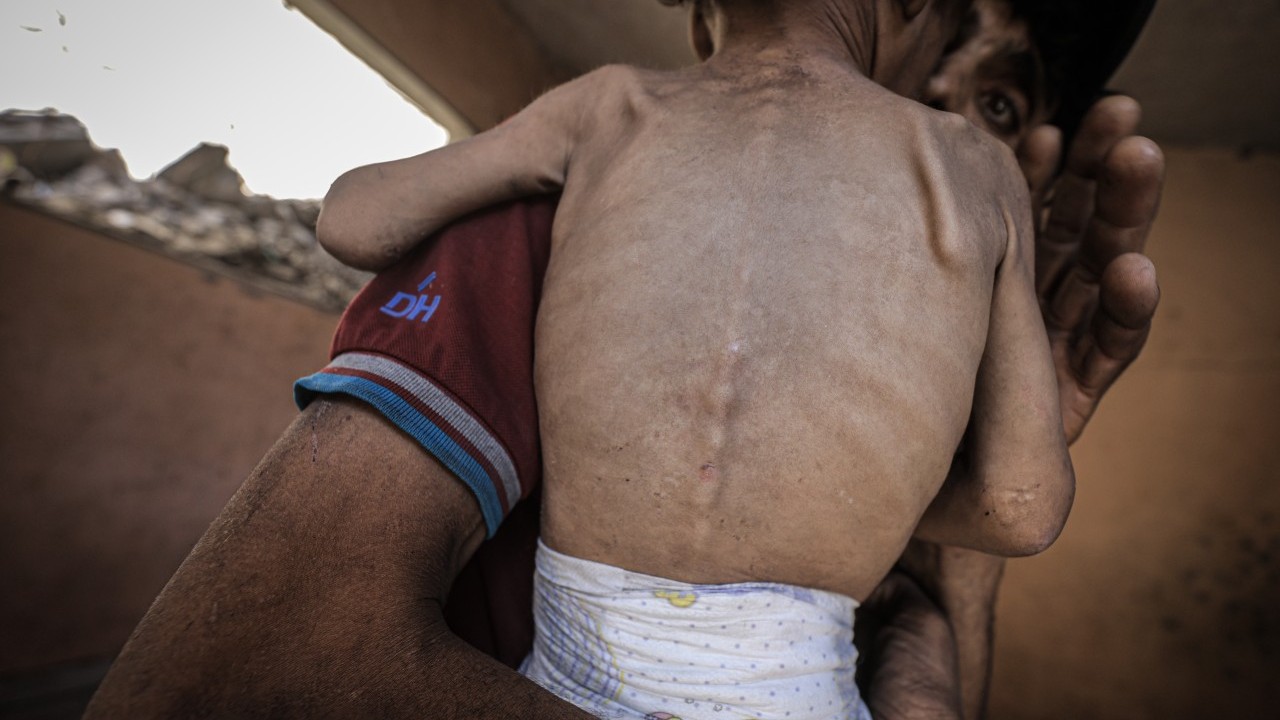 Foto - 2 yaşında... Ölümle karşı karşıya!..