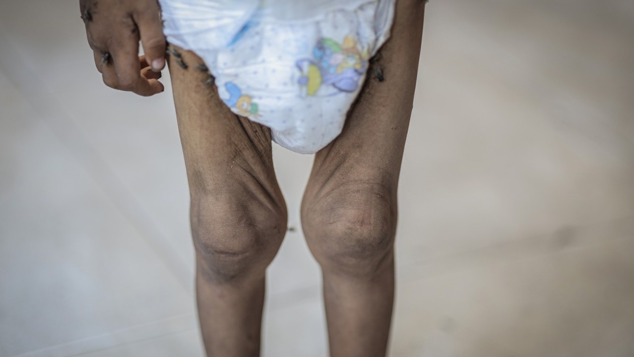 Foto - 2 yaşında... Ölümle karşı karşıya!..