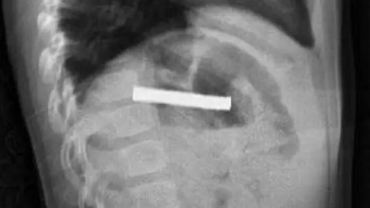 3 yaşındaki çocuk doktorları şaşırttı! Hepsini nasıl yuttun evlat!