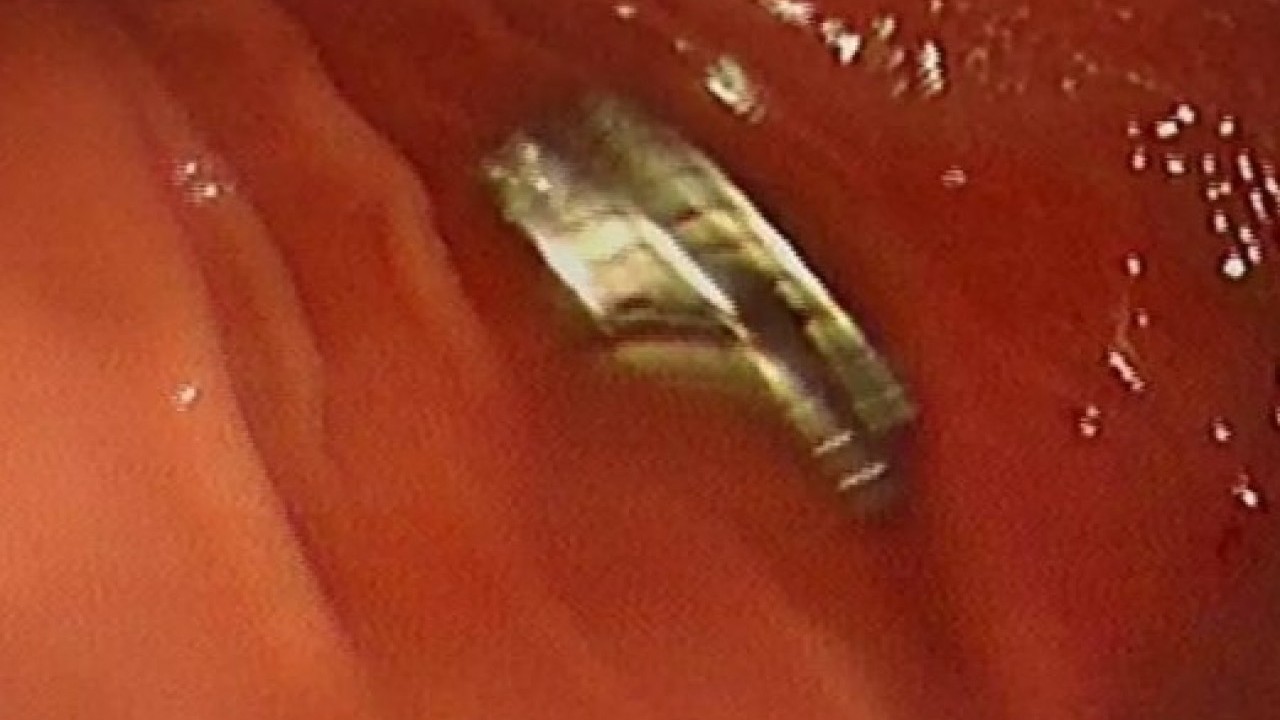 Foto - 3 yaşındaki çocuk doktorları şaşırttı! Hepsini nasıl yuttun evlat!