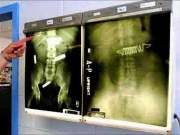 Foto - 36 yıl sonra midesinden kardeşi çıktı!