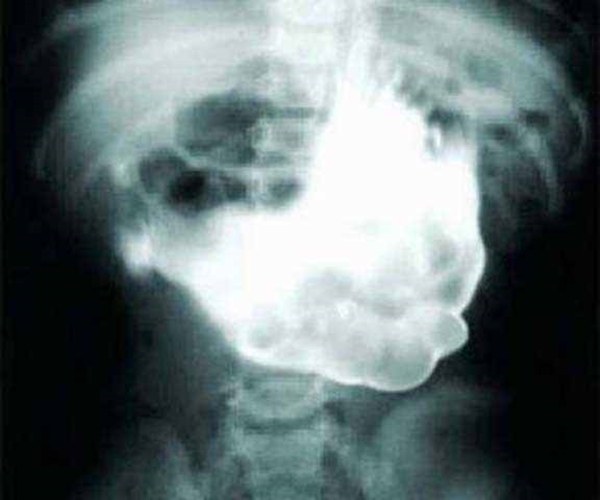 Foto - 36 yıl sonra midesinden kardeşi çıktı!