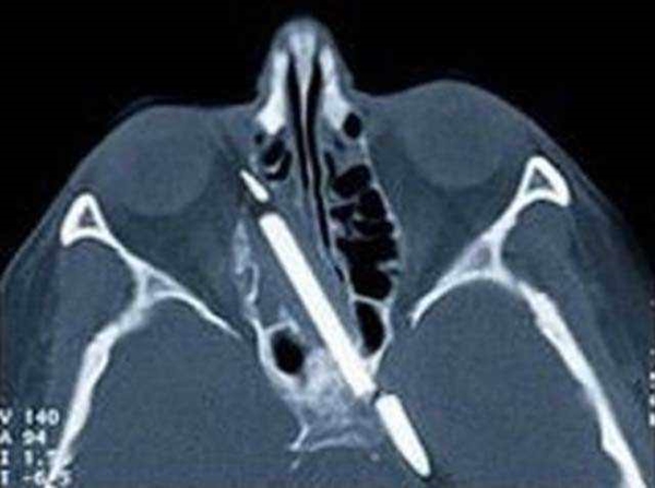 Foto - 36 yıl sonra midesinden kardeşi çıktı!