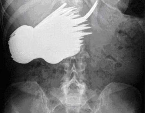 Foto - 36 yıl sonra midesinden kardeşi çıktı!