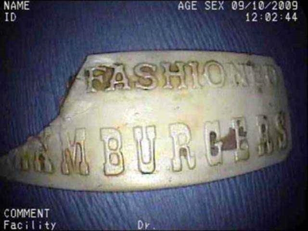 Foto - 36 yıl sonra midesinden kardeşi çıktı!