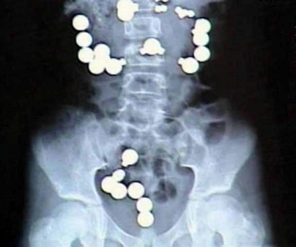 Foto - 36 yıl sonra midesinden kardeşi çıktı!