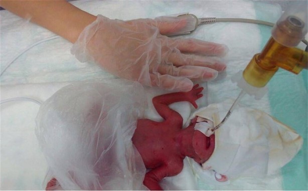 Foto - 380 gram doğmuştu, hayata tutundu!