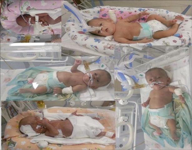 Foto - 380 gram doğmuştu, hayata tutundu!