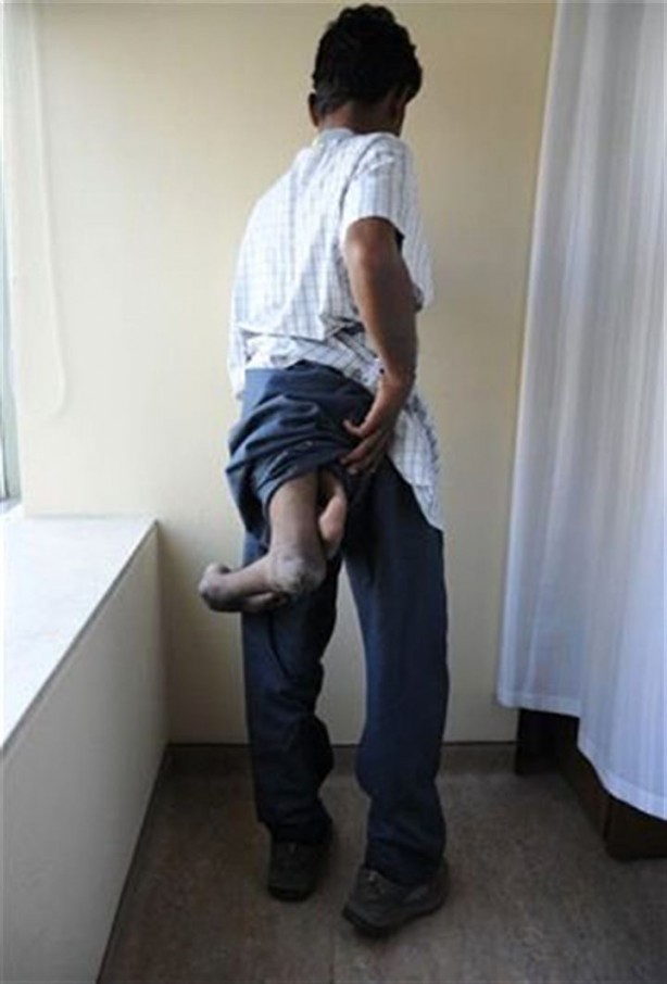 Foto - 4 bacaklı adam görenleri hayrete düşürüyor