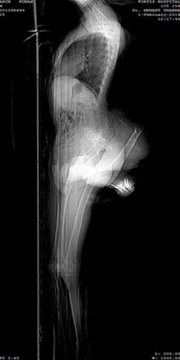 Foto - 4 bacaklı adam görenleri hayrete düşürüyor