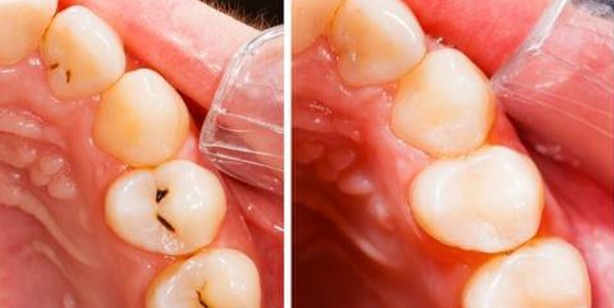 40 Yıl düşünseniz aklınıza gelmez çürük dişleri eski haline getiriyormuş! İlaç yerine seçmeye başladılar