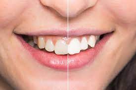 Foto - 40 Yıl düşünseniz aklınıza gelmez çürük dişleri eski haline getiriyormuş! İlaç yerine seçmeye başladılar