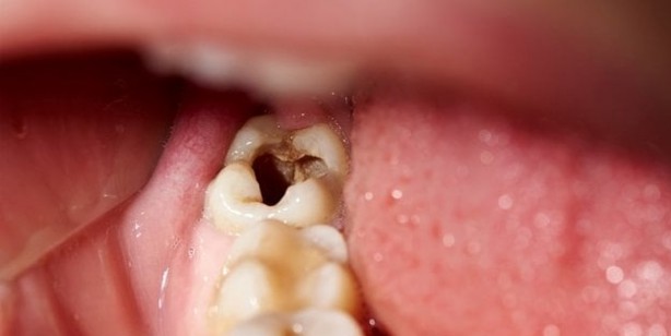 Foto - 40 Yıl düşünseniz aklınıza gelmez çürük dişleri eski haline getiriyormuş! İlaç yerine seçmeye başladılar