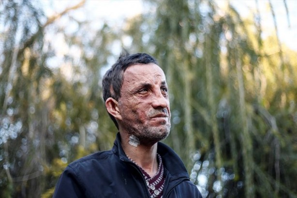 Foto - 7 yıl önce yüz nakli olmuştu... İşte son hali