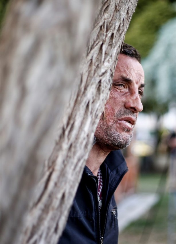 Foto - 7 yıl önce yüz nakli olmuştu... İşte son hali