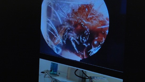 Foto - 70 yaşındaki kadının kulağında hareket eden kene görüldü