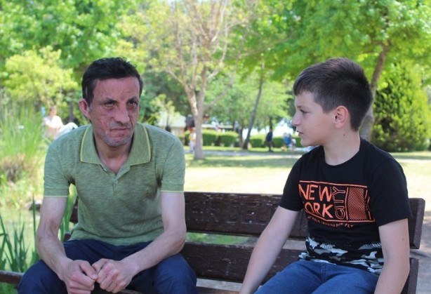 Foto - 7,5 yıl önce yüz nakli olmuştu! İşte son hali