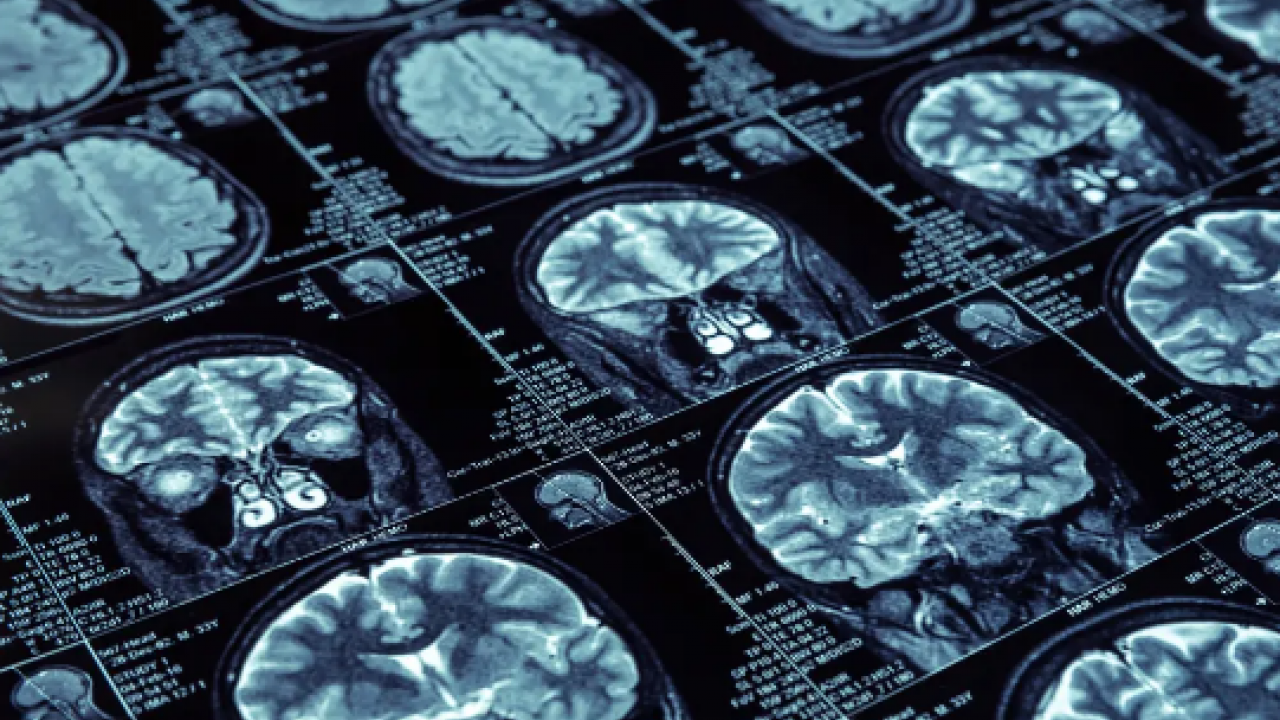 793 yetişkinin kanında... Orta yaşta D vitamini Alzheimer’a karşı kalkan olabilir