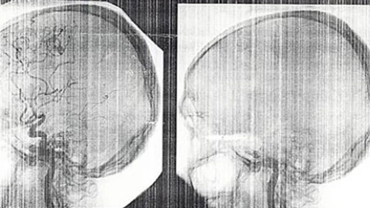 A kan grubundaki böbrek, 0'a dönüştürüldü!
