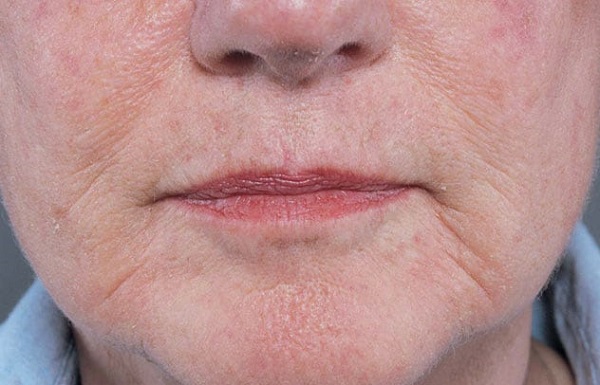 Foto - ABD'de herkes bu yöntemi kullanıyor! Cilt sorunlarına kesin çözüm