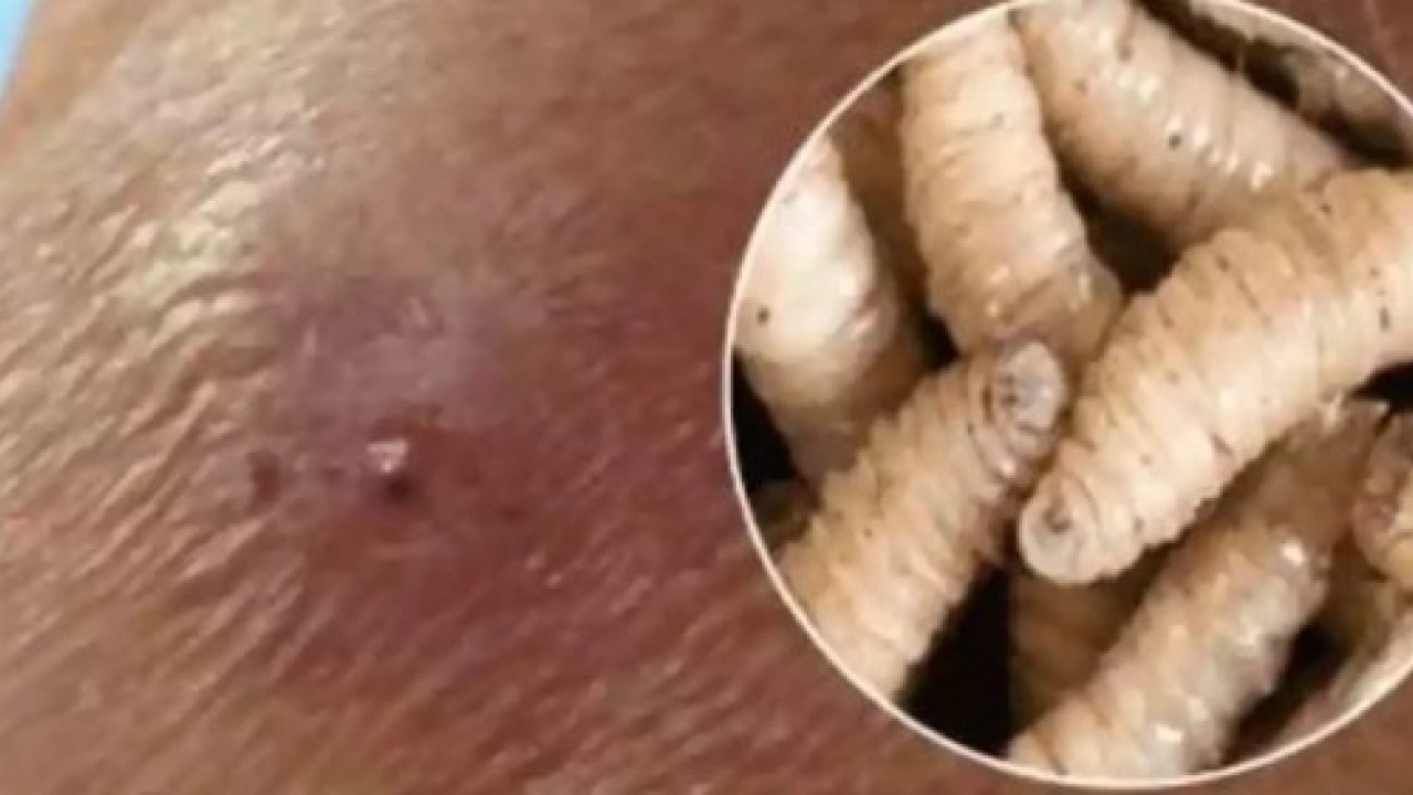 Foto - ABD'de kayda geçti: İlk kez insan vücuduna sızdı!