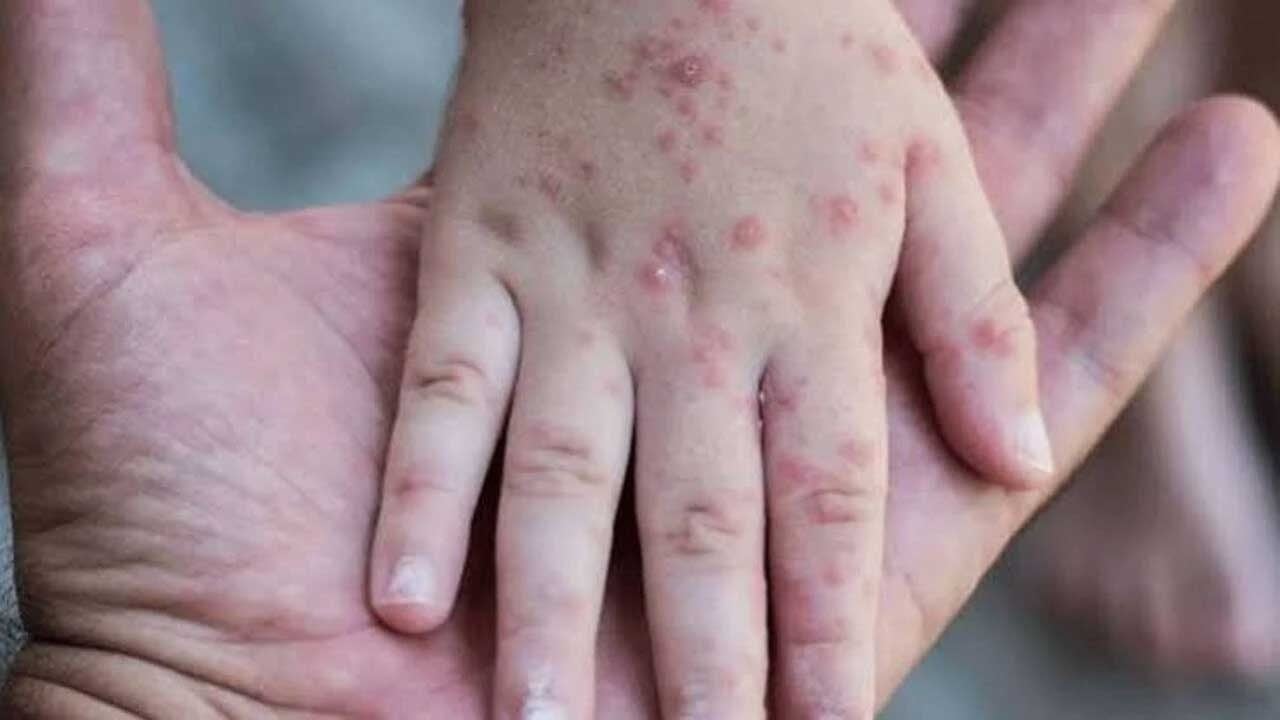 Foto - ABD'de kızamık vakası patladı