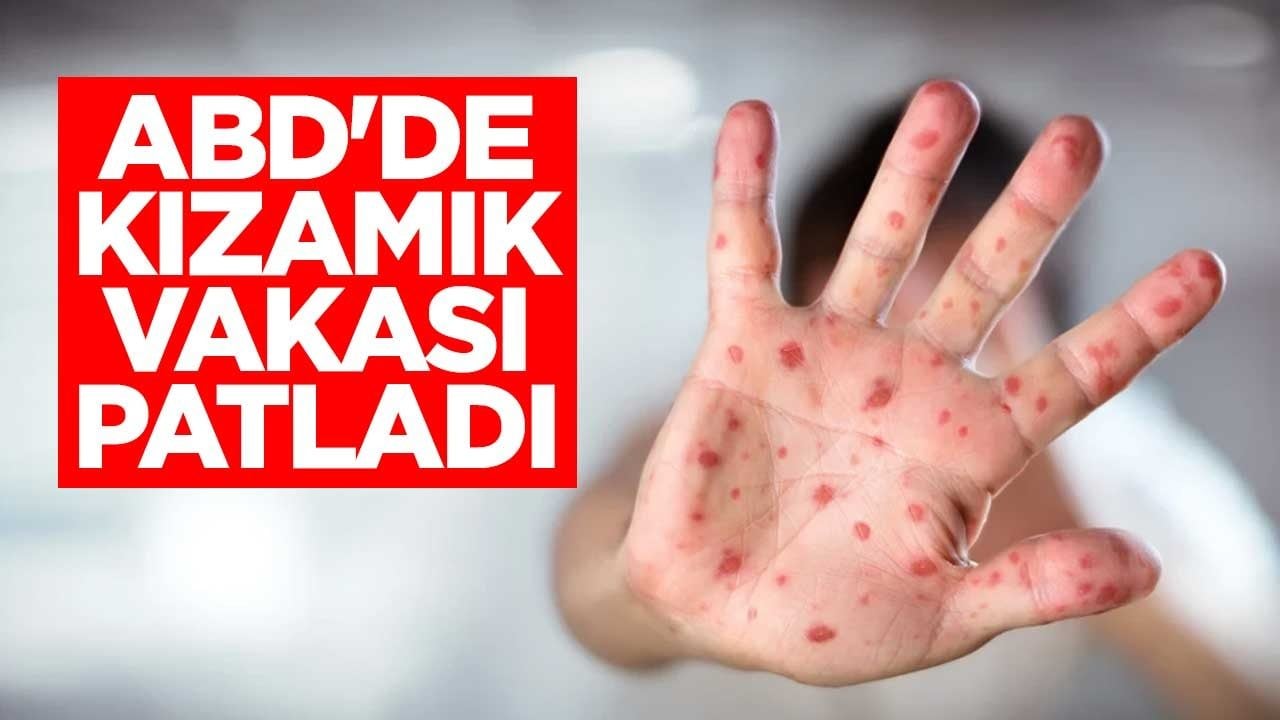 ABD'de kızamık vakası patladı