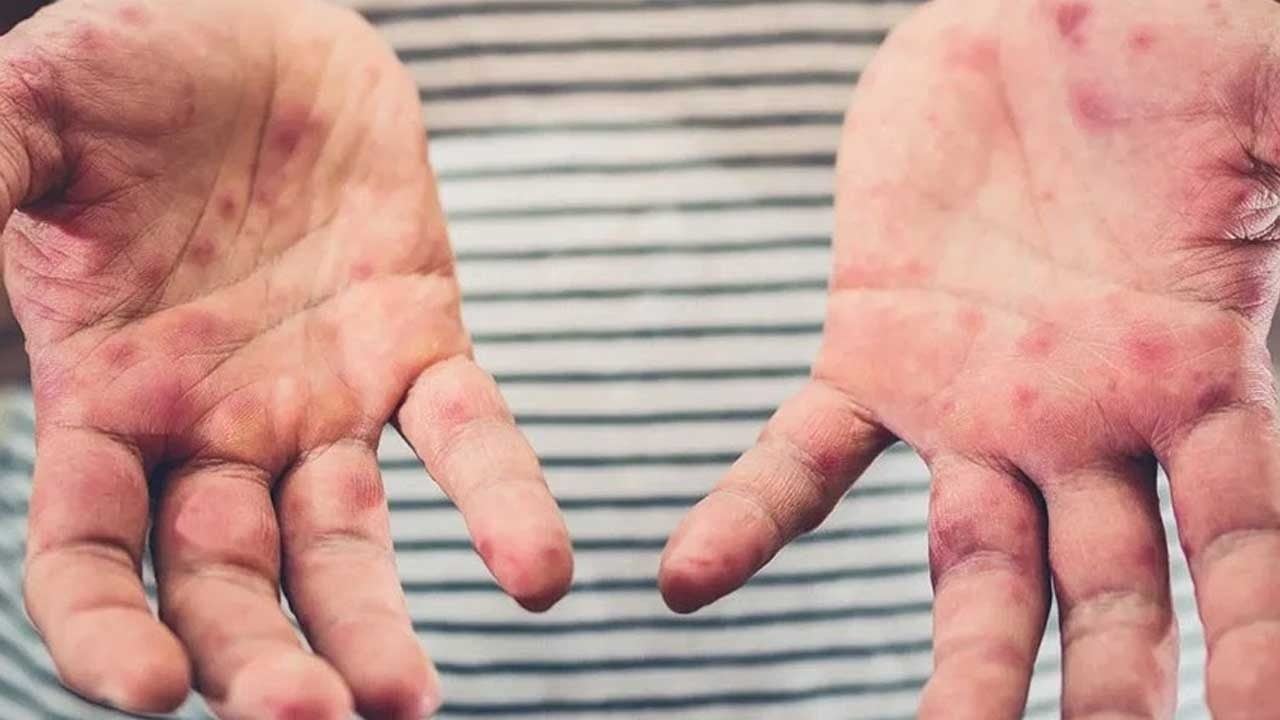 Foto - ABD'de kızamık vakası patladı