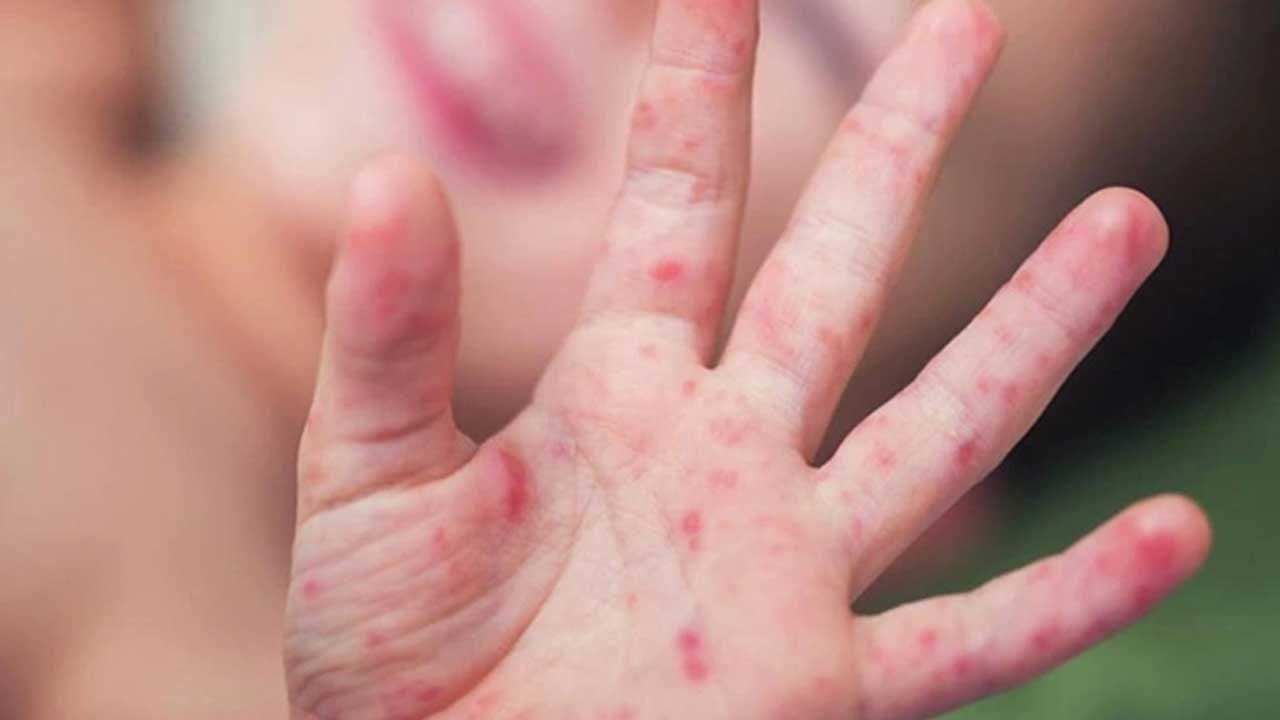 Foto - ABD'de kızamık vakası patladı