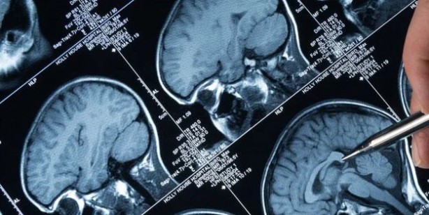 Foto - ABD'li bilim insanları tarihi keşif diyerek duyurdu: 86 farklı insanda test alzheimer için umut verdi!